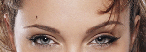 Forehead Acne Causes