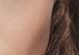 Cheek Acne Causes