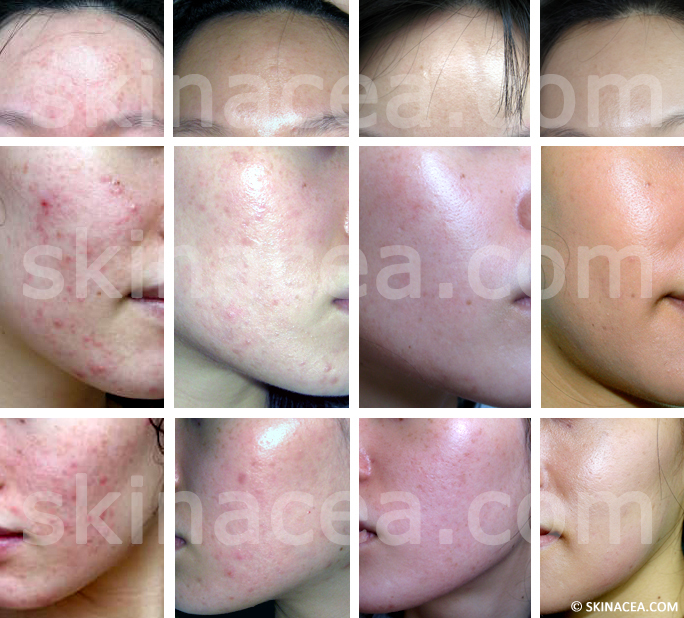 My Acne Before and After Pictures | Skinacea.com