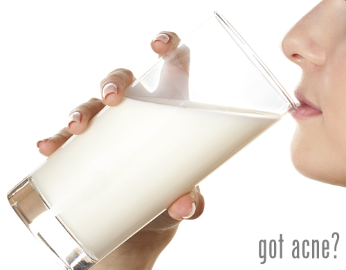 Milk causes acne for some people