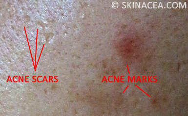 What's the difference between acne and marks? | Skinacea.com