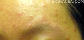 Picture of forehead acne