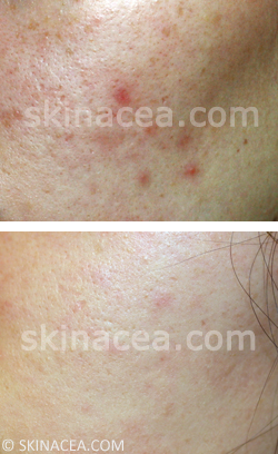 indhold kasseapparat ekspedition How to Fade Post-Acne Red Marks, Dark Spots, Pigmentation, Etc. |  Skinacea.com