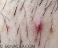 Ingrown hair