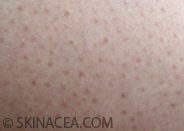 Keratosis Pilaris