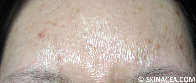 Crepey skin from a TCA peel